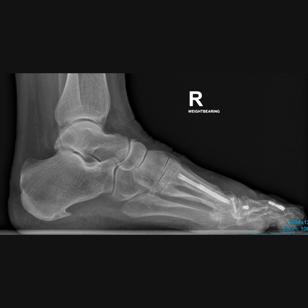 An x-ray of a person 's foot with a screw in it.