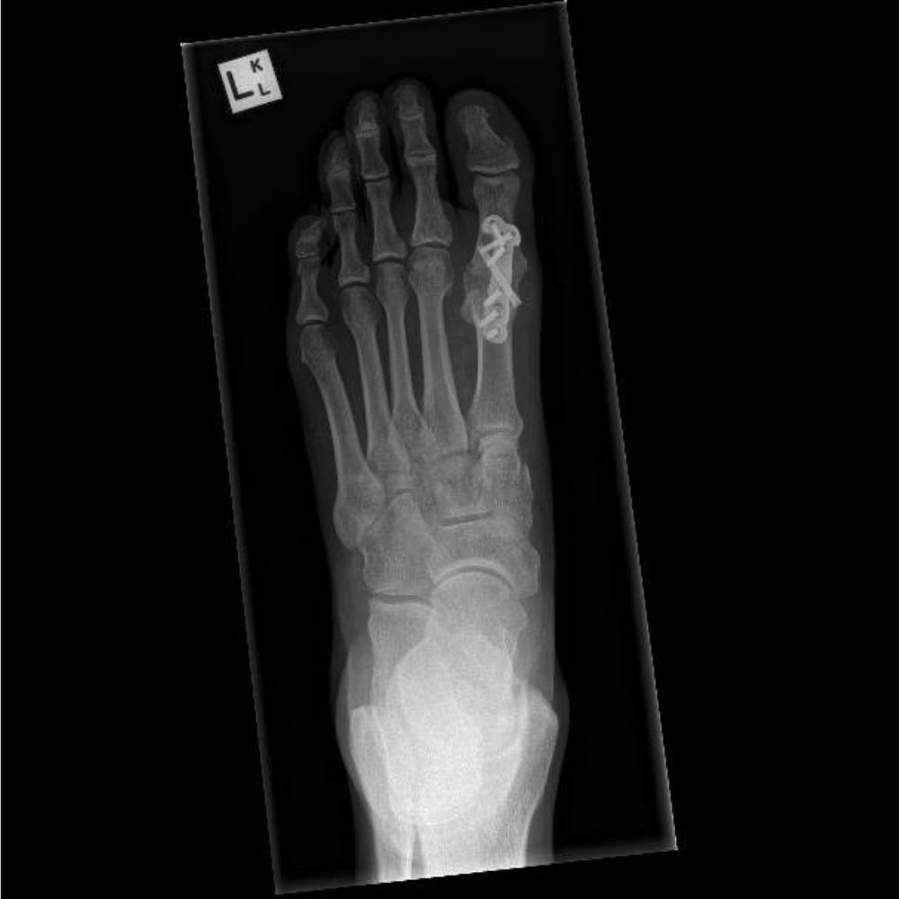 An x-ray of a foot with the letter l on it