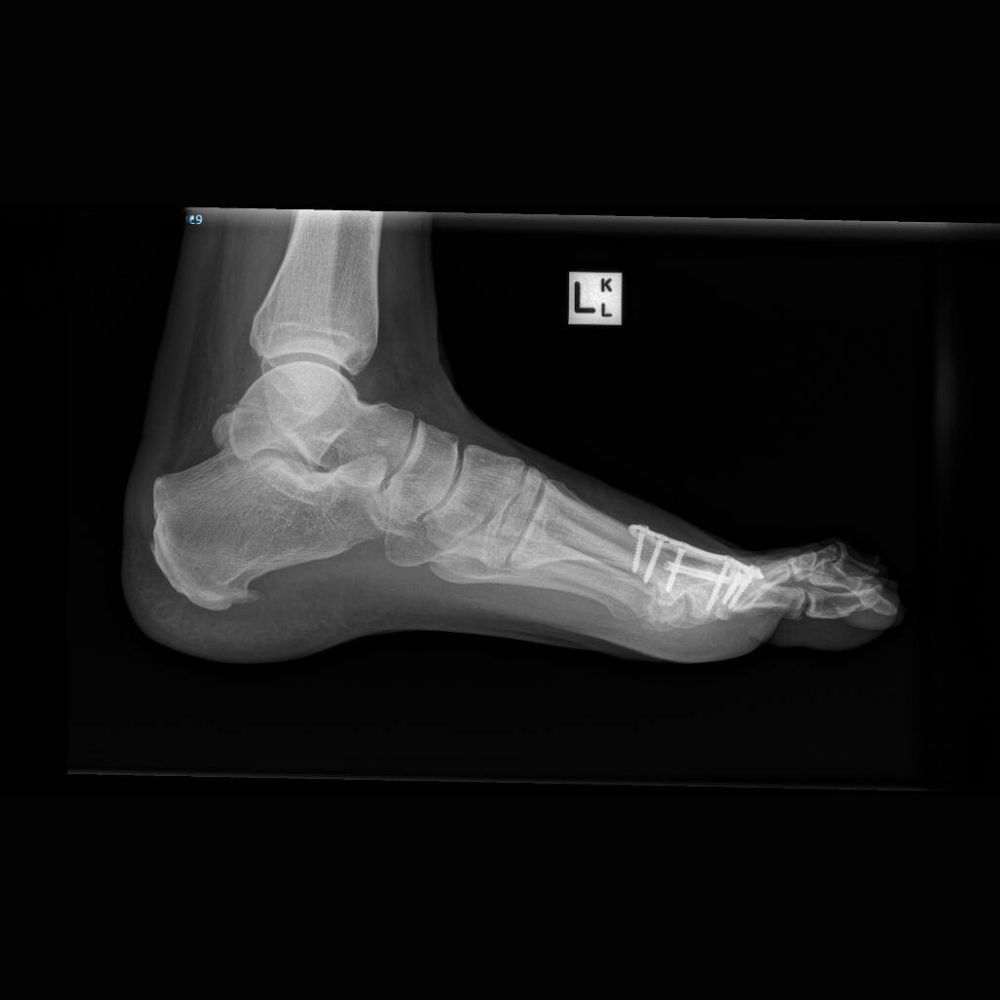 X-ray of patient's foot after surgery