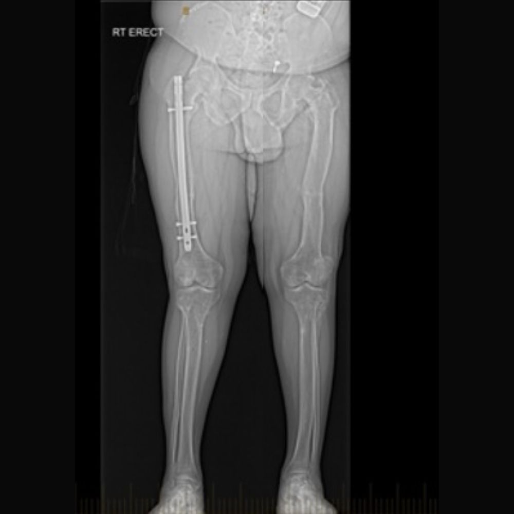 An x-ray of a person 's legs with a broken leg.