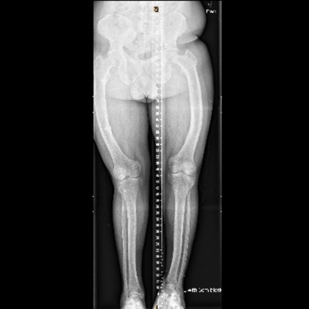 A black and white x-ray of a person 's legs with a ruler.