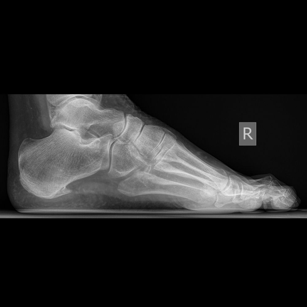 An x-ray of a person 's foot showing the bones of the foot.