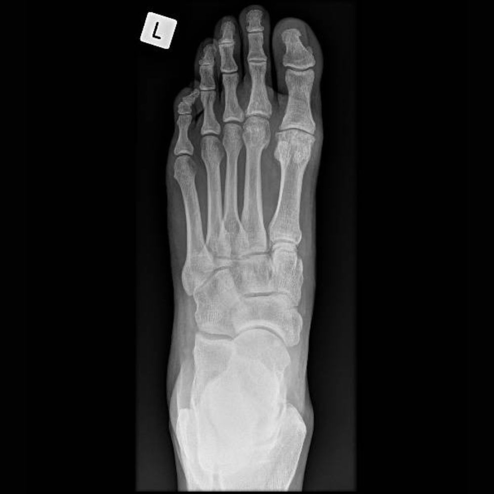 An x-ray of a foot with a square labeled l on it.