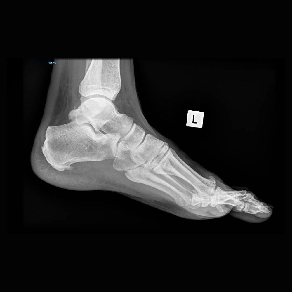 An x-ray of a person 's foot showing the bones of the foot.