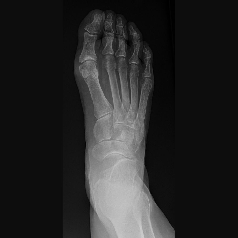 An x-ray of a person 's foot showing the bones of the foot.