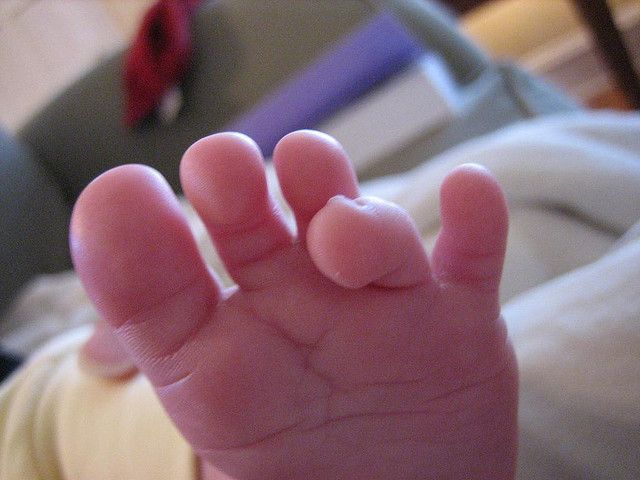Clinical picture of a curly toe