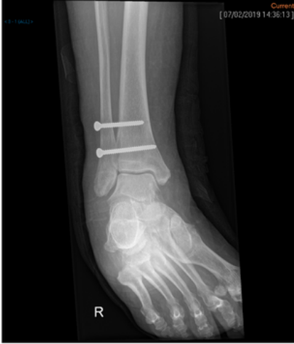 A diagram of a normal achilles tendon and an achilles tendon rupture.