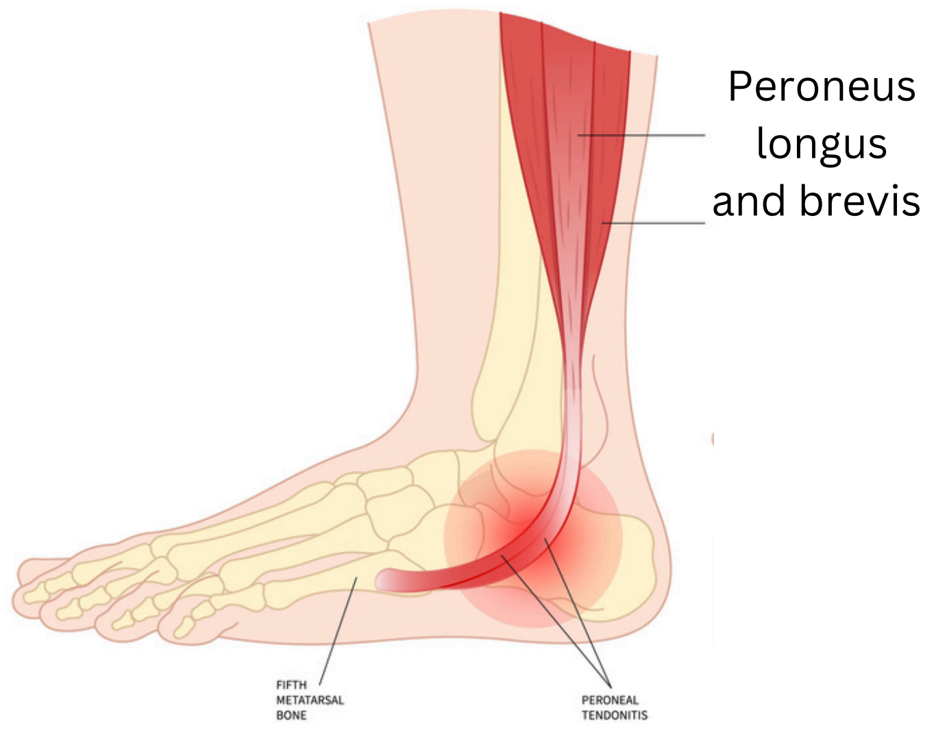 A diagram of a normal achilles tendon and an achilles tendon rupture.