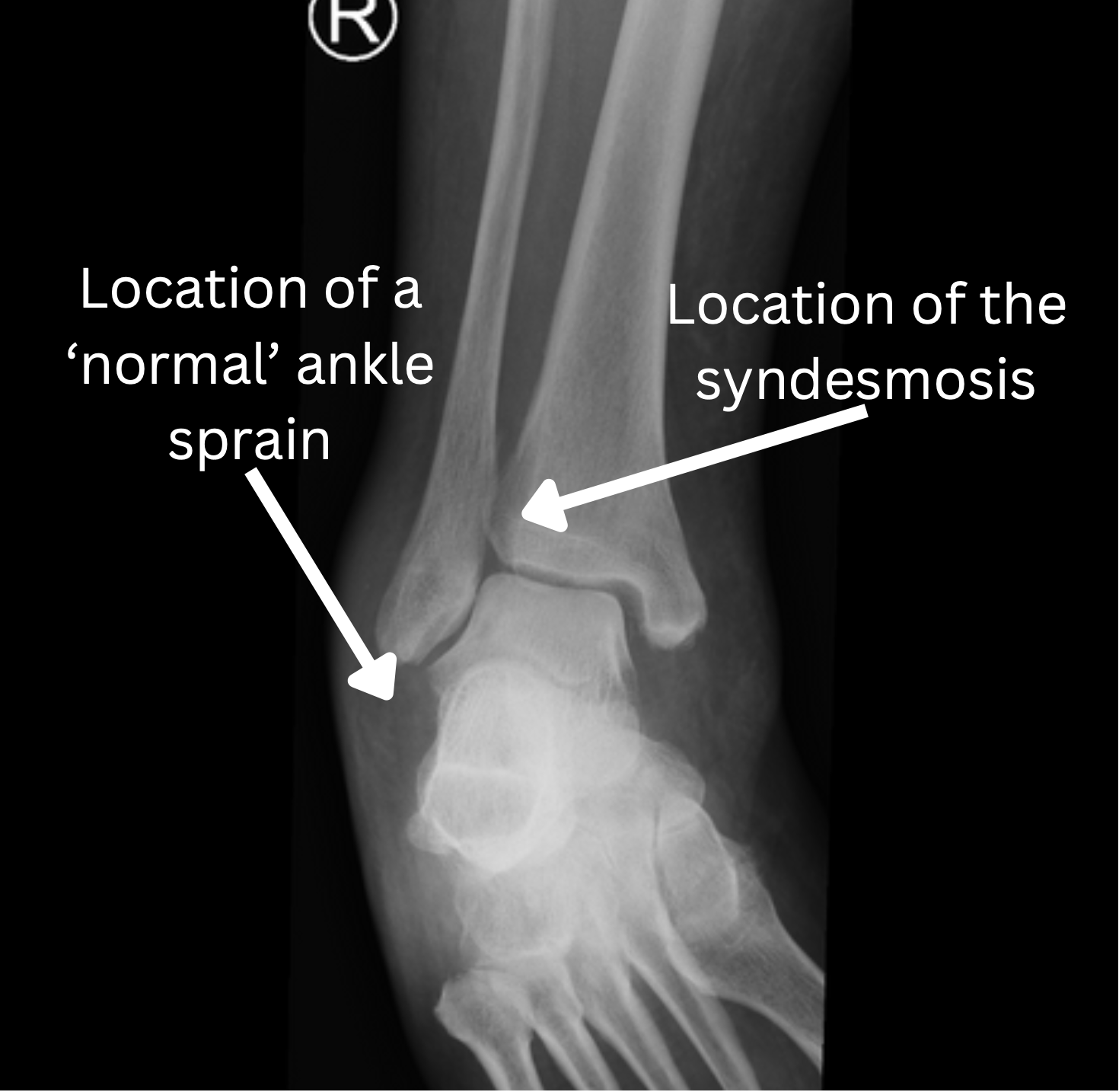 Syndesmosis Injuries Dr Christy Graff Adelaide SA
