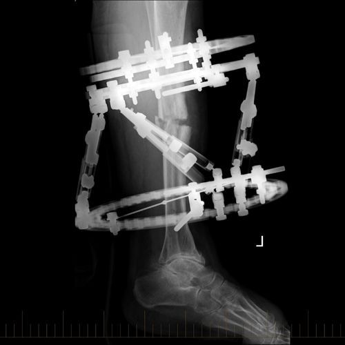 An x-ray of a person 's leg with a brace on it.