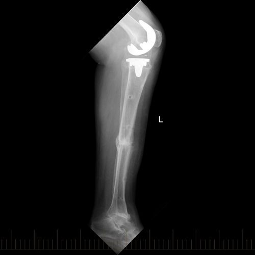 An x-ray of a person 's leg with a prosthetic leg.
