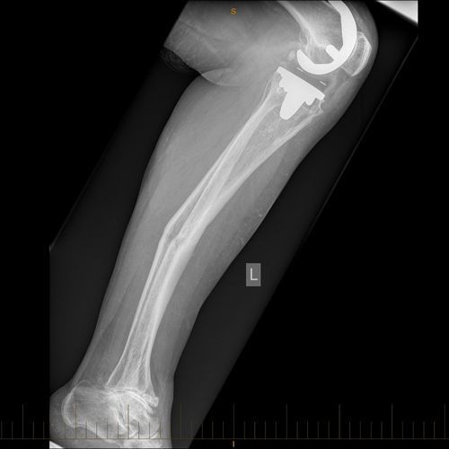 An x-ray of a person 's arm with a knee replacement.