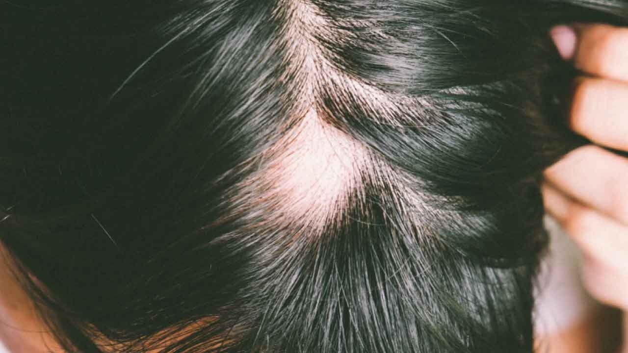 Close-up of a Scalp With Thinning Hair — A9 Skin and Hair Clinic In Westmead, NSW