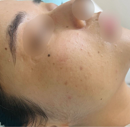 Close-up of a Person's Face Lying on Their Side — A9 Skin and Hair Clinic In Westmead, NSW