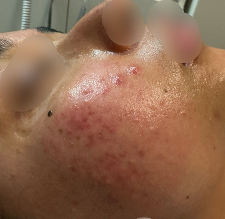 Close-up of a Cheek With Red — A9 Skin and Hair Clinic In Westmead, NSW