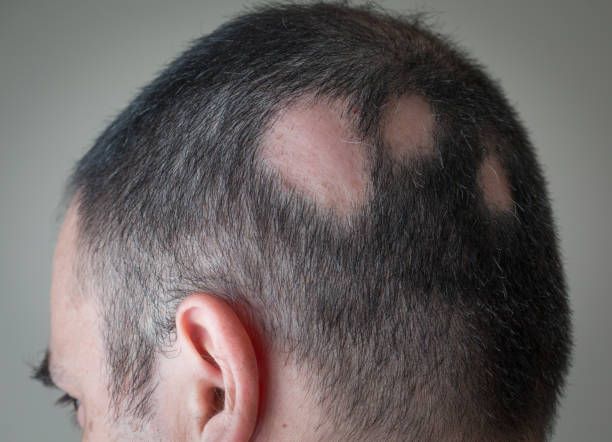 Close-up of a Balding Scalp With Several Circular Patches — A9 Skin and Hair Clinic In Westmead, NSW