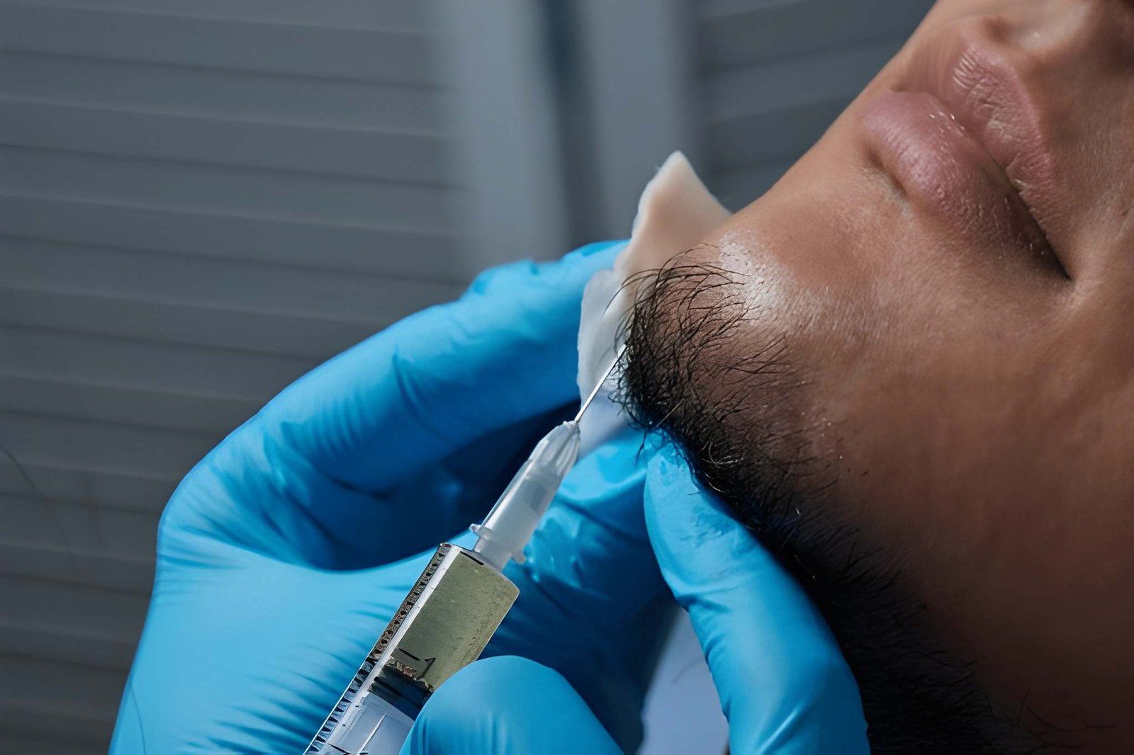 Blue-gloved Hand Injecting Filler — A9 Skin and Hair Clinic In Westmead, NSW
