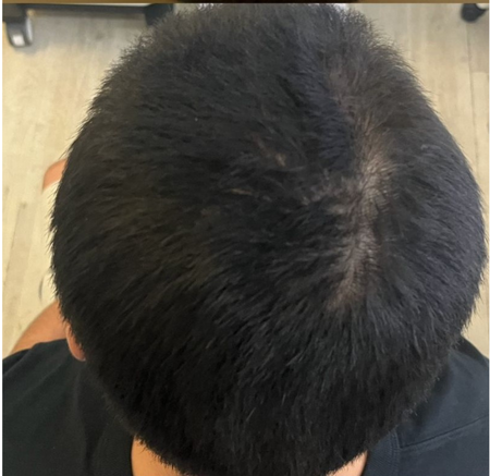 Top View of a Person’s Dark Hair and Scalp — A9 Skin and Hair Clinic In Westmead, NSW