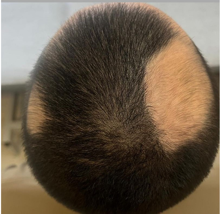 Top View of a Scalp With a Large Circular Bald — A9 Skin and Hair Clinic In Westmead, NSW