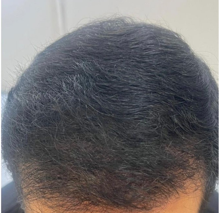 Close-up of Dark Hairline at the Top of a Person's Head — A9 Skin and Hair Clinic In Westmead, NSW