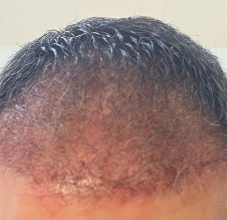 Close-up of a Receding Hairline With Short Dark Hair — A9 Skin and Hair Clinic In Westmead, NSW