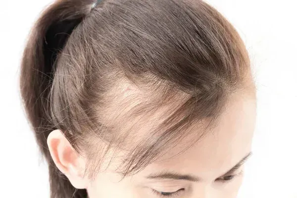 Close-up of a Person With Brown Hair Tied Back — A9 Skin and Hair Clinic In Westmead, NSW