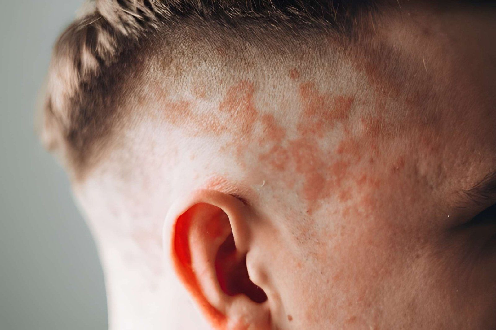 Close-up of a Person’s Ear — A9 Skin and Hair Clinic In Westmead, NSW