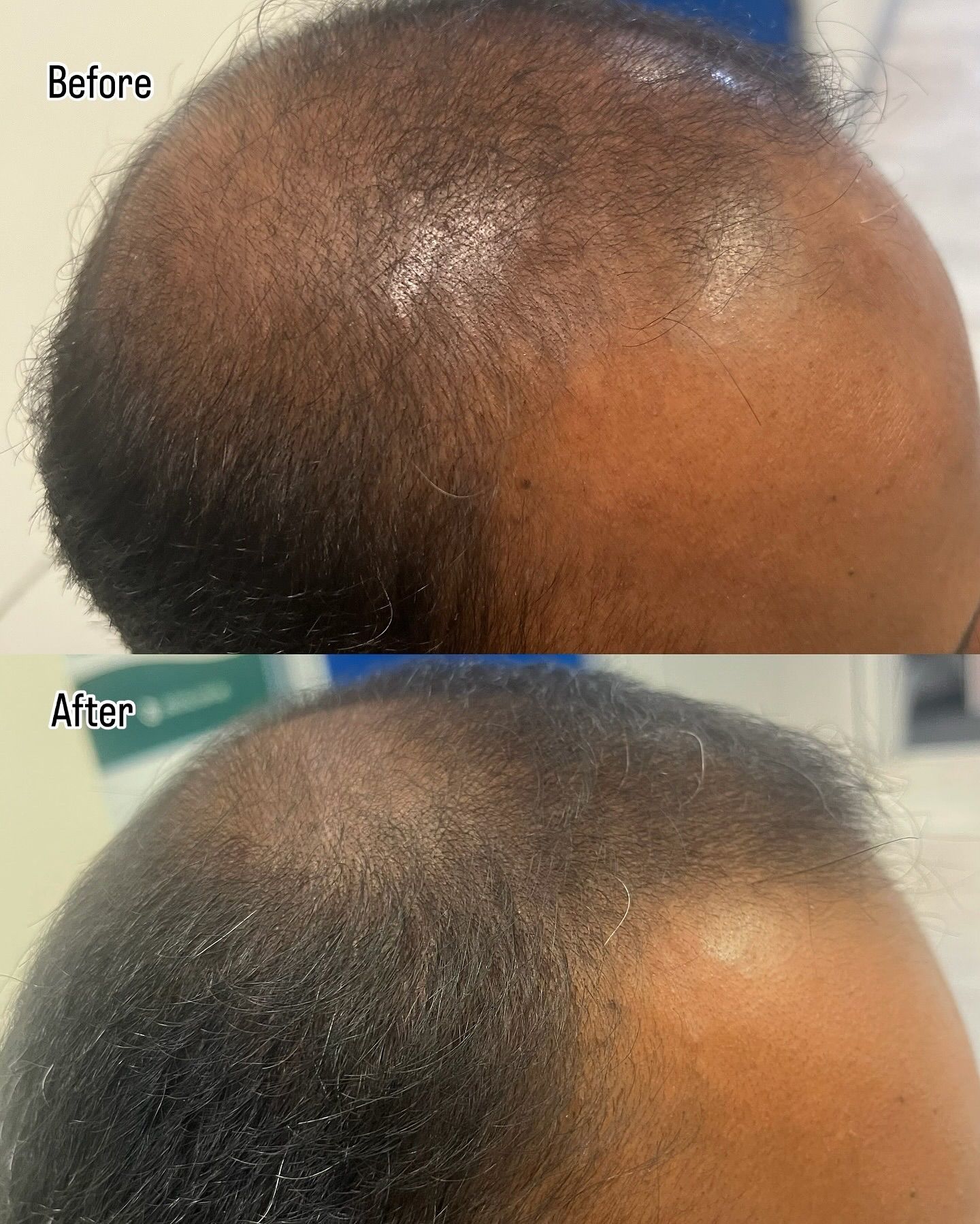 Before-and-after Close-up of a Shaved Scalp — A9 Skin and Hair Clinic In Westmead, NSW