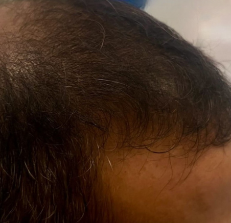 Close-up of a Person’s Thinning Hairline — A9 Skin and Hair Clinic In Westmead, NSW