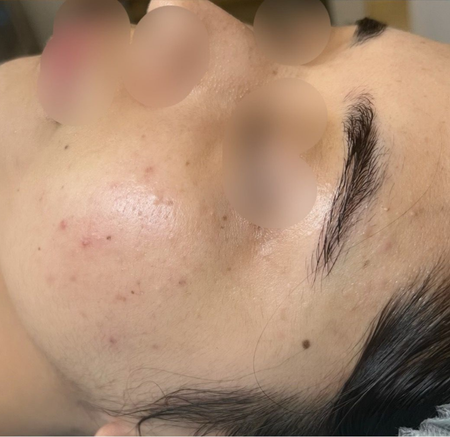 Close-up Side View of a Face — A9 Skin and Hair Clinic In Westmead, NSW