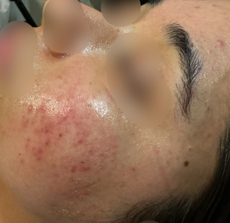 Close-up of a Cheek With a Red — A9 Skin and Hair Clinic In Westmead, NSW