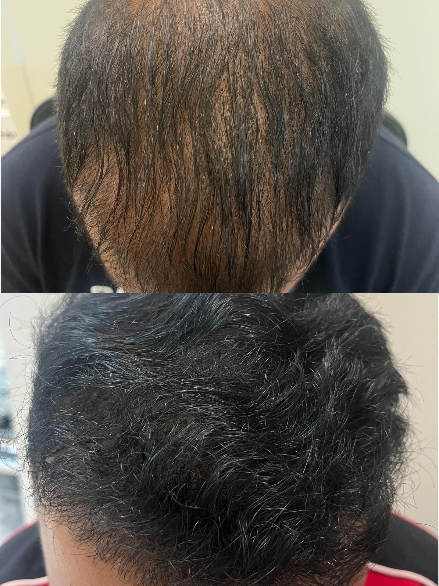 Top and Back Views of a Head — A9 Skin and Hair Clinic In Westmead, NSW