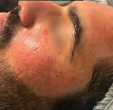 Close-up of a Face With a Red — A9 Skin and Hair Clinic In Westmead, NSW