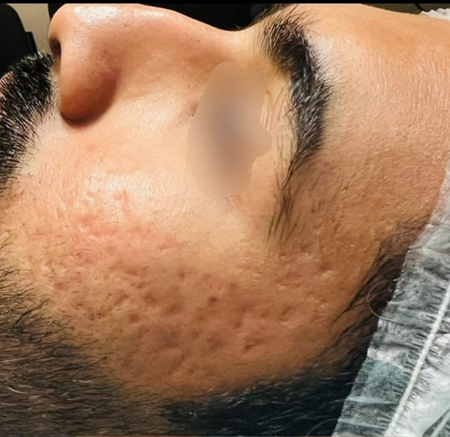 Close-up of a Facial Cheek — A9 Skin and Hair Clinic In Westmead, NSW