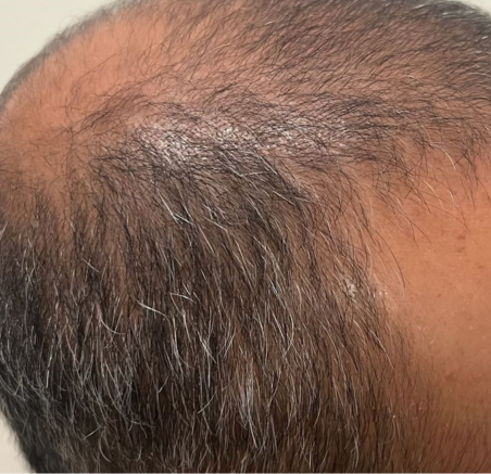 Close-up of a Balding Scalp — A9 Skin and Hair Clinic In Westmead, NSW