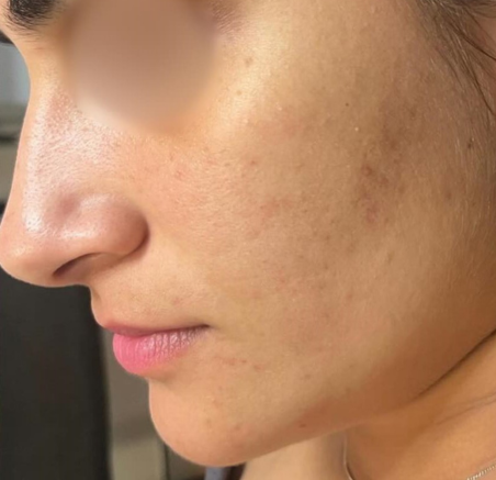 Side-profile Close-up of a Person’s Face — A9 Skin and Hair Clinic In Westmead, NSW