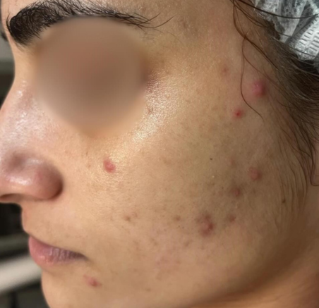 Close-up Profile of a Face With Several Red Acne — A9 Skin and Hair Clinic In Westmead, NSW