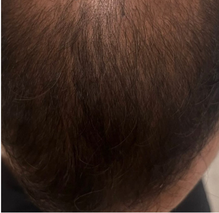 Close-up of a Thinning Scalp With Sparse Brown Hair — A9 Skin and Hair Clinic In Westmead, NSW