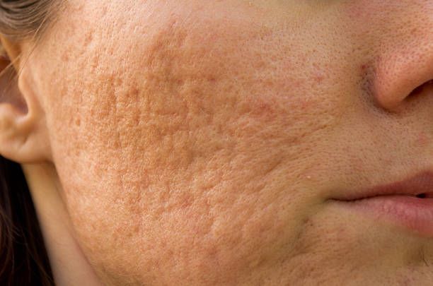 Close-up of a Person's Cheek — A9 Skin and Hair Clinic In Westmead, NSW