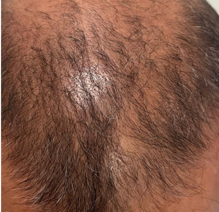 Close-up of a Scalp — A9 Skin and Hair Clinic In Westmead, NSW