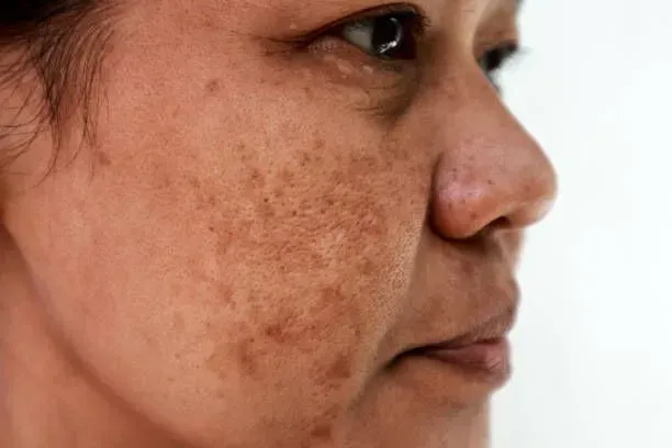 Close-up Side Profile of a Person’s Face — A9 Skin and Hair Clinic In Westmead, NSW