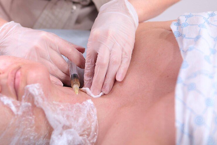 Gloved Hands Insert a Needle — A9 Skin and Hair Clinic In Westmead, NSW