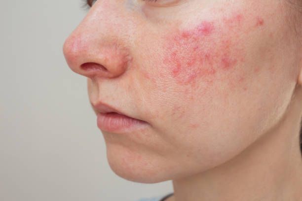 Close-up of a Cheek With Red Acne-like Blemishes on Pale Skin — A9 Skin and Hair Clinic In Westmead, NSW
