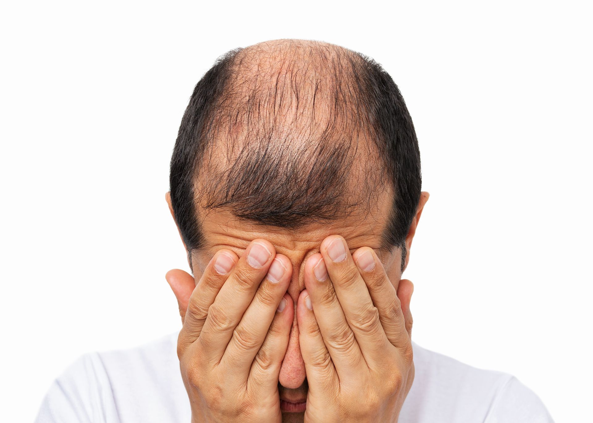 Person With Thinning Hair Covering Their Face — A9 Skin and Hair Clinic In Sydney, NSW