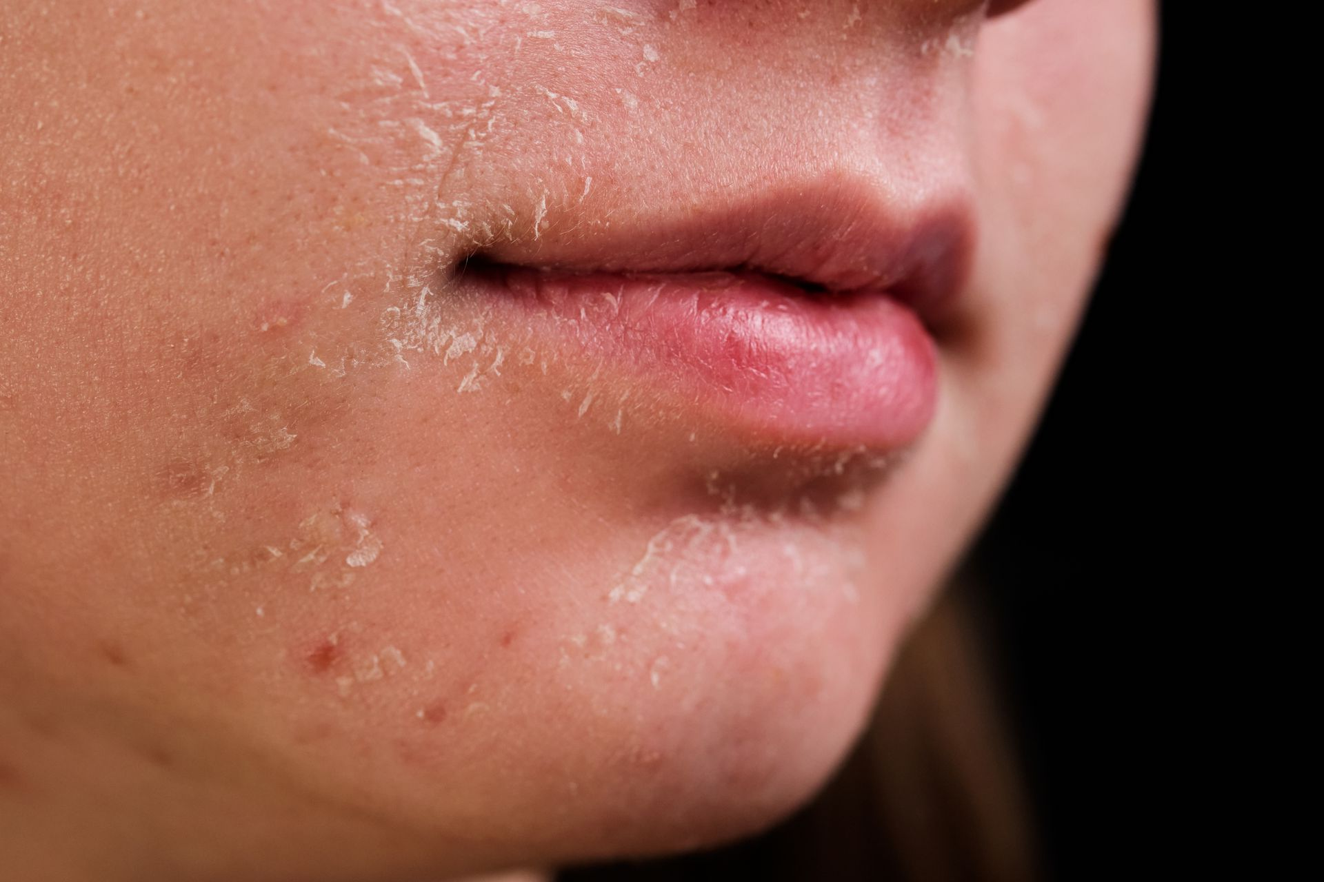 Close-up of a Person’s Chin and Lips — A9 Skin and Hair Clinic In Westmead, NSW