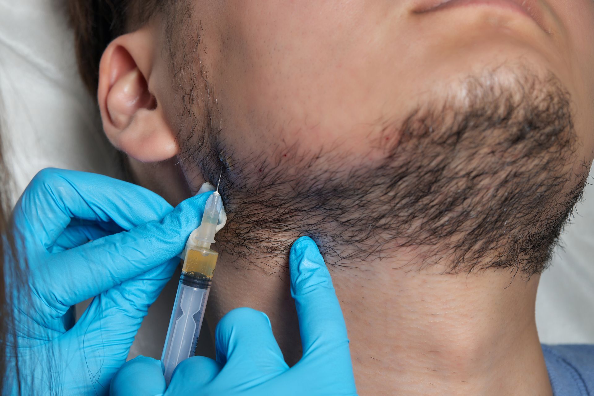 Gloved Hands Injecting a Syringe Into a Man’s Beard — A9 Skin and Hair Clinic In Westmead, NSW