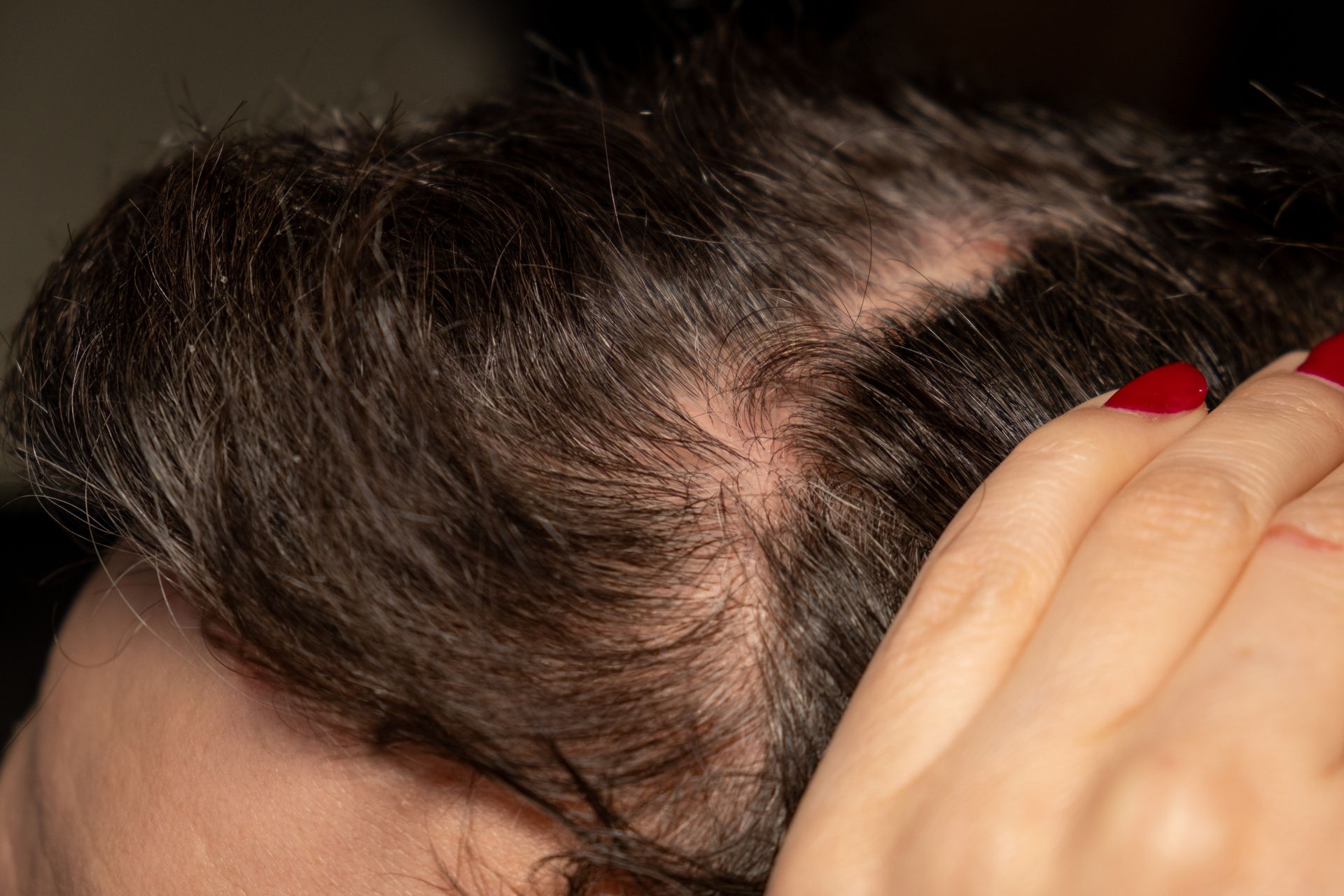 Close-up of a Scalp With Thinning Hair — A9 Skin and Hair Clinic In Westmead, NSW