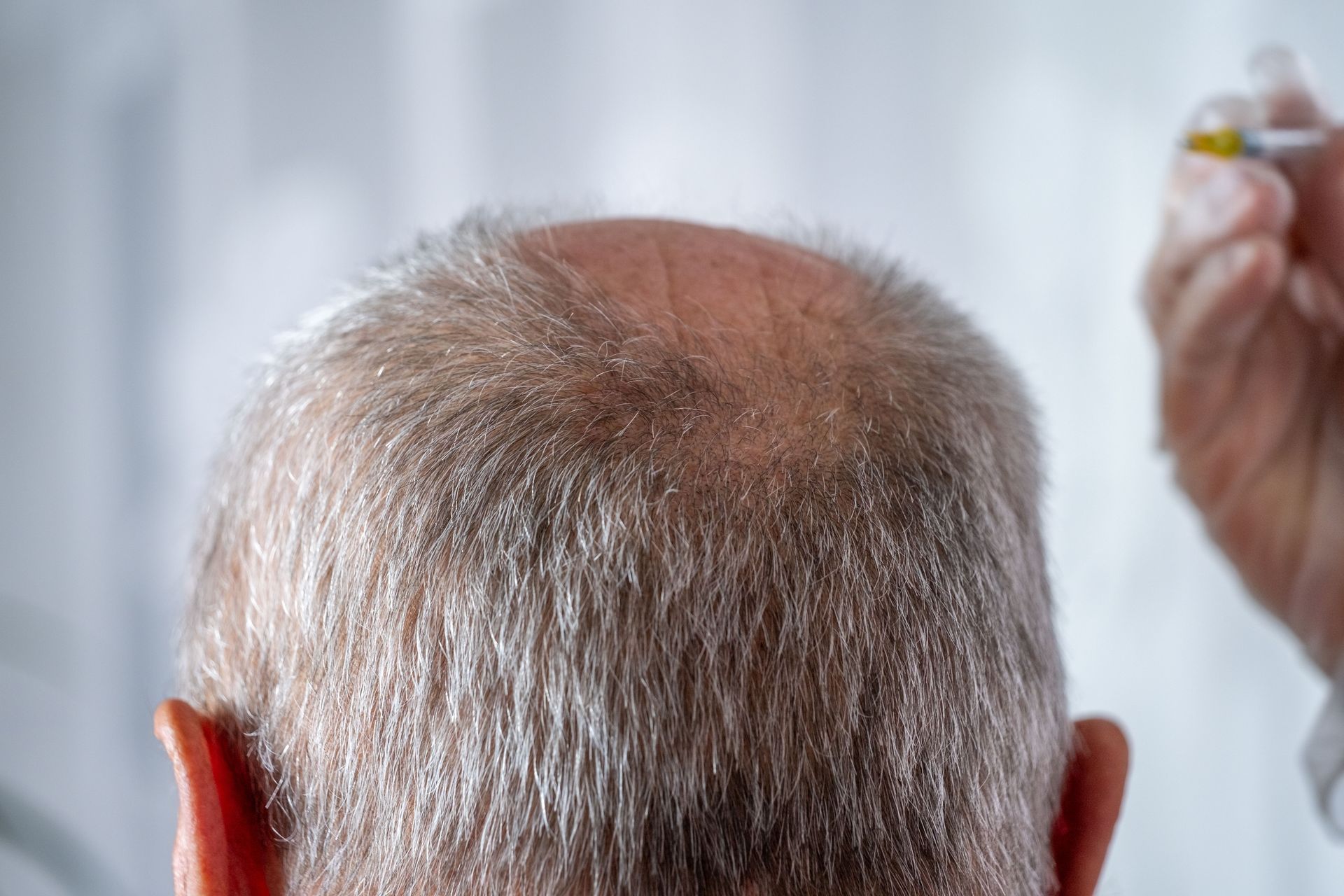 Back of a Bald Man’s Head While a Hand Holds — A9 Skin and Hair Clinic In Western Sydney, NSW