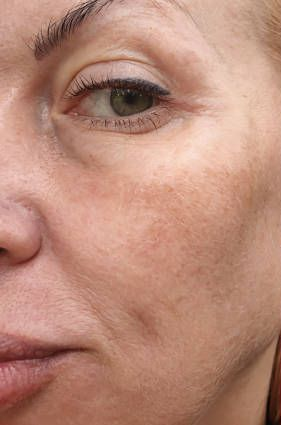 Close-up of a Face With Visible Skin Texture — A9 Skin and Hair Clinic In Westmead, NSW