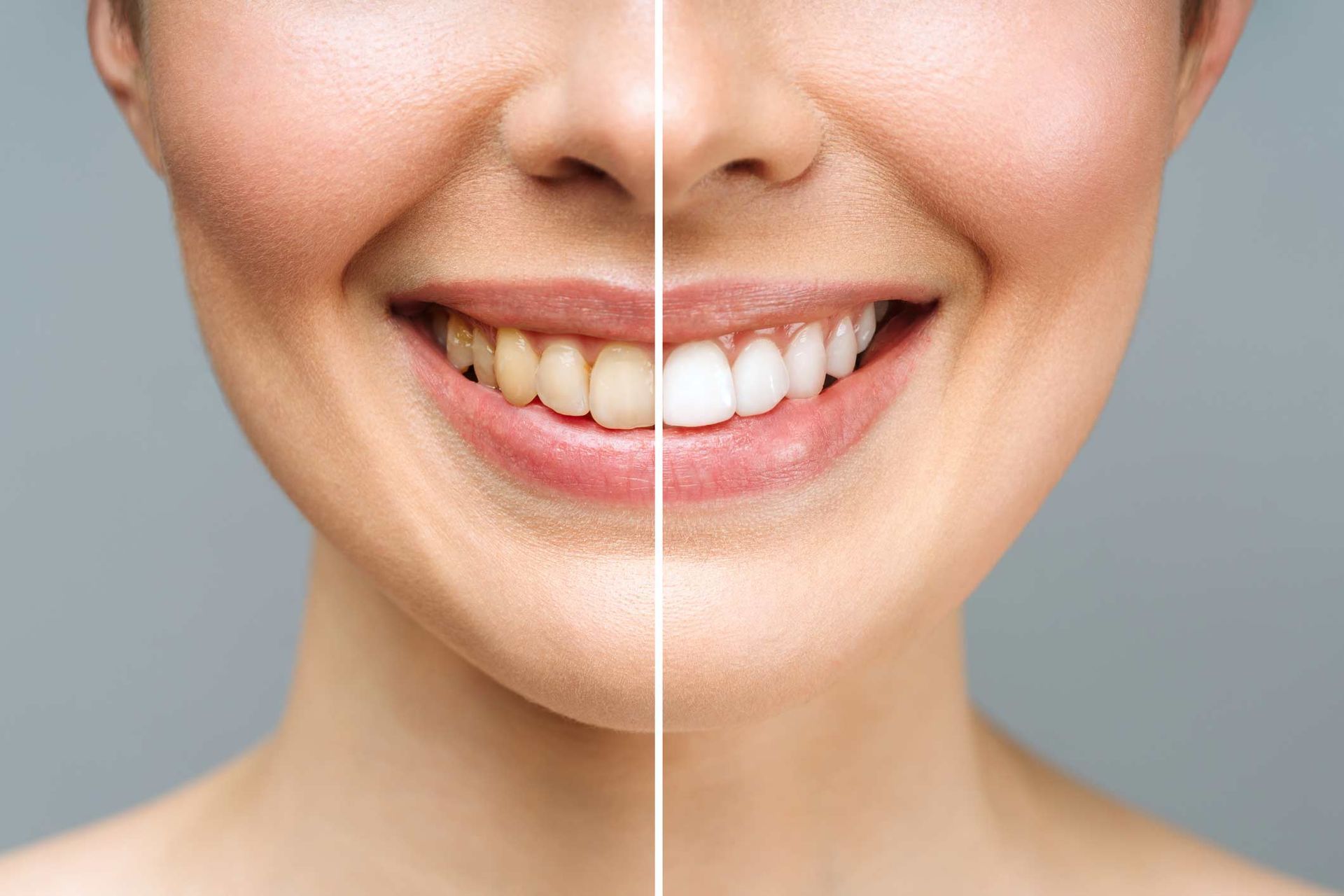 Teeth Whitening — Bloomington, MN — Oxboro Dental Care